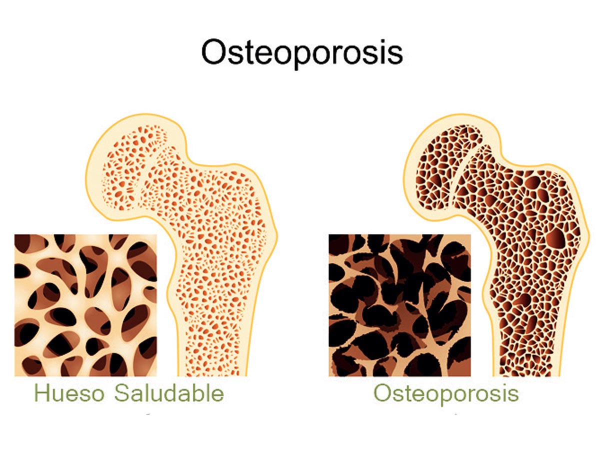 osteoporosis-hueso-2
